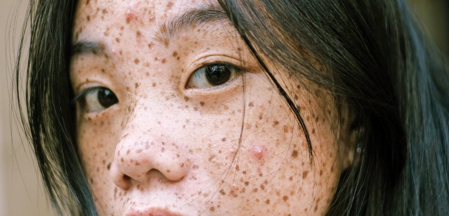 Close-up photography of girl's face with freckles 